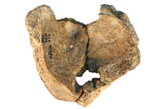 china-parietal-foramen