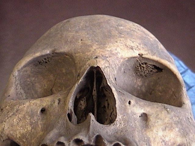 skull cribra orbitalia
