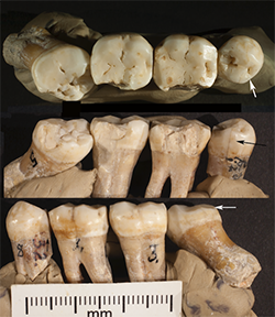 Croatia Neanderthal Dentistry KU