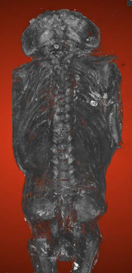 Egypt mummy anencephaly
