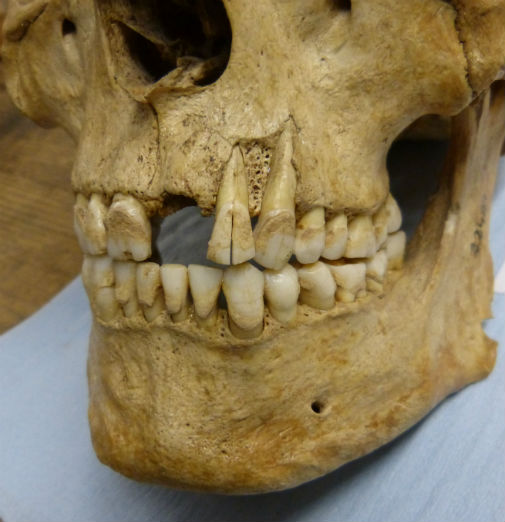 Britain dental plaque