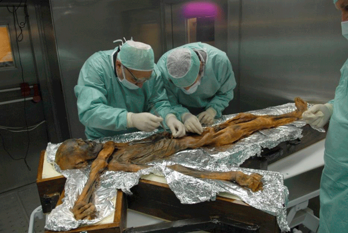 Mummies-Heart-Disease-Otzi