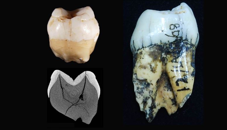 Sumatra human tooth