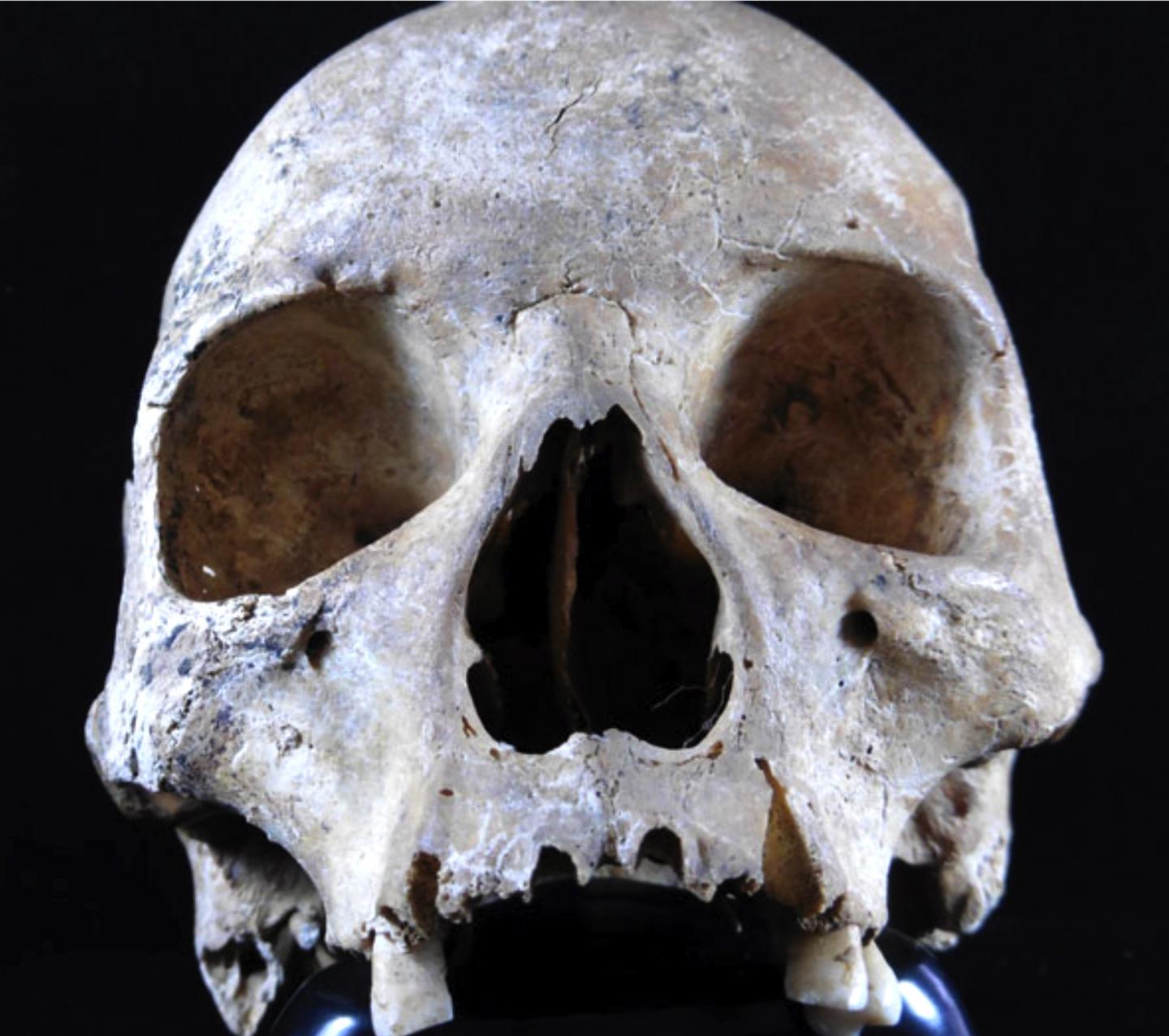 England leprosy skull