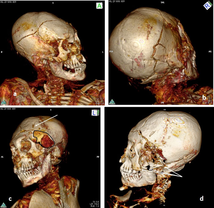 Mummy Skull CT Scan