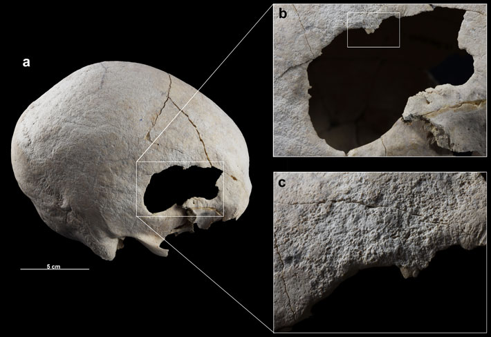 Hallan en España evidencias de una cirugía de cráneo de hace 4.500 años
