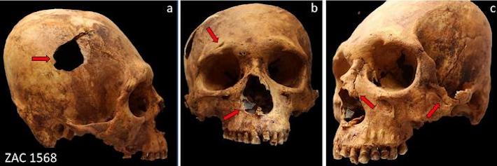 Peru Skull Traumatic Injuries